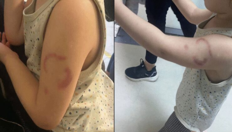 Kreşte akıl almaz olay: Öğrencisini ısıran öğretmen tutuklandı