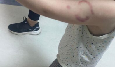 Kreşte kan donduran olay: Öğretmen çocuğun kolunu ısırdı