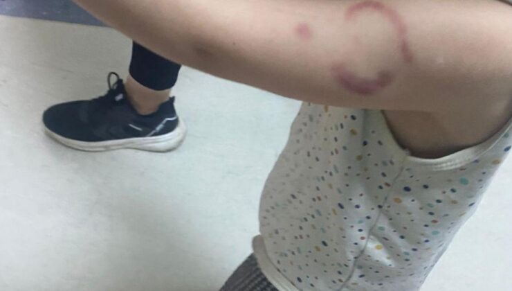 Kreşte kan donduran olay: Öğretmen çocuğun kolunu ısırdı