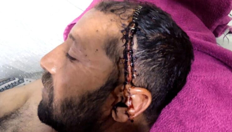 Kafa yarıp 92 dikiş atmanın cezası 1 yıl