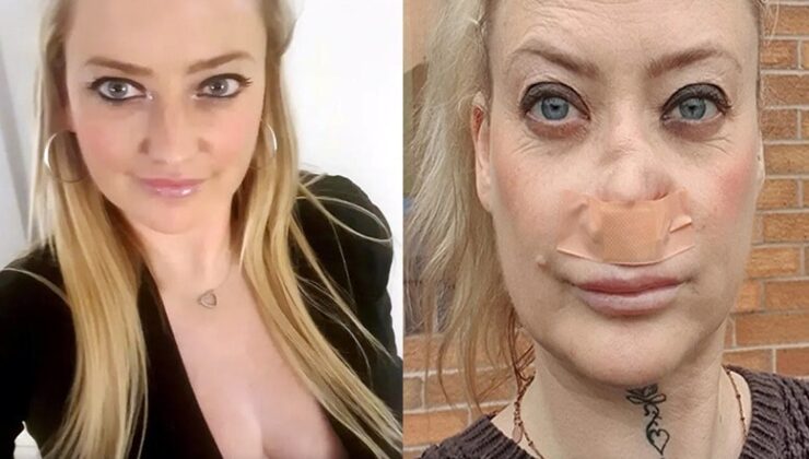 Antalya tatilinde dişlerini yaptıran turistin burnu çöktü!