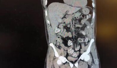 Fas’tan Beşiktaş’a midesinde uyuşturucu getirdi: Ameliyatla çıkarıldı