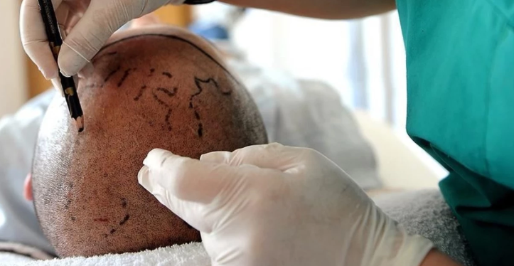 Saç ekim koordinatörü hapsi boyladı! Kendini doktor olarak tanıttı, saç ekti