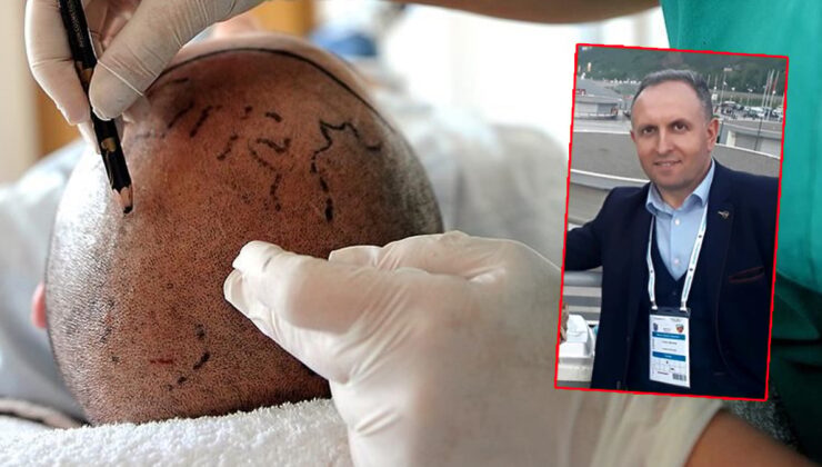 Saç ekimi sonu oldu