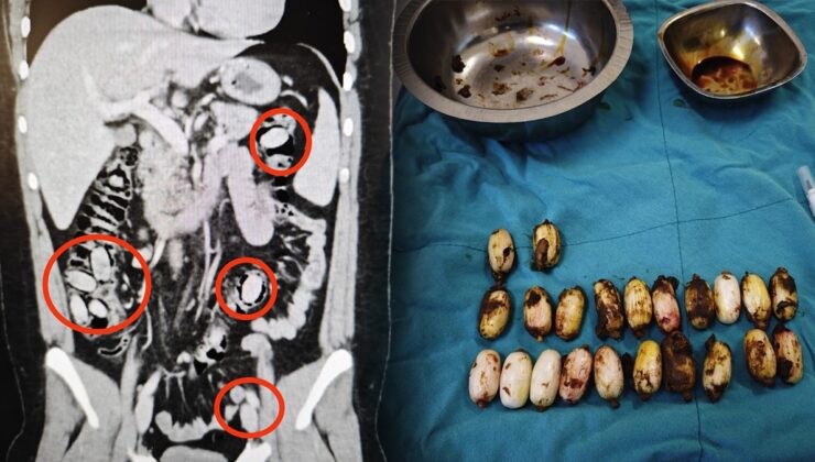 Yurt dışından geldi: Midesinden çıkanlar ağızları açık bıraktı