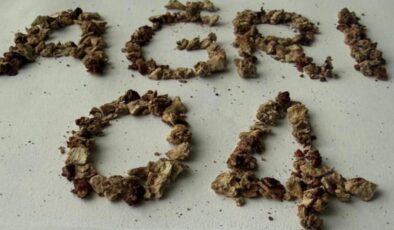 Ameliyata alınan hastadan 295 adet böbrek taşı çıkarıldı!